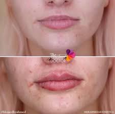 thin lips fillers lips enhancement