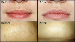 remove unwanted upper lip hair chin