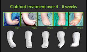 Most of the time, clubfoot can be corrected while your child is a still a baby. Clubfoot Children S Orthopaedic And Scoliosis Surgery Associates Llp