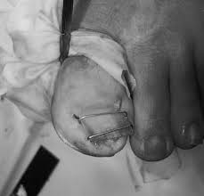 treatment for severe incurved toenails