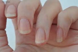 how eczema affected my nails nail