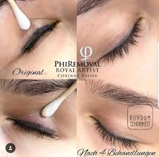 permanent makeup removal methods