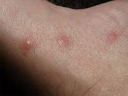 flea bites vs bed bug bites how to