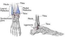 Image result for icd 10 code for nondisplaced right medial malleolus fracture