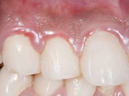 white spots and sores on gums causes