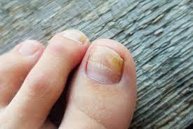fungal nail infections onychomycosis