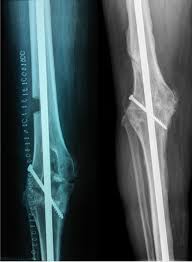 knee arthrodesis for infected revision