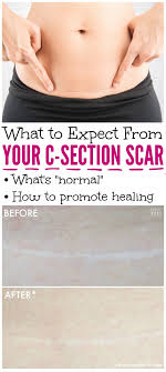 your c section scar 5 things you need