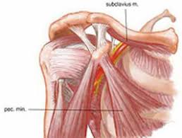 shoulder impingement syndrome pinched
