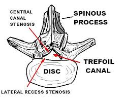 spinal canal stenosis คือ