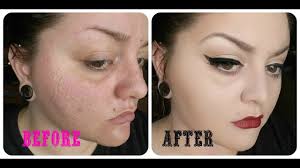 deep acne scar cover up 2016 you
