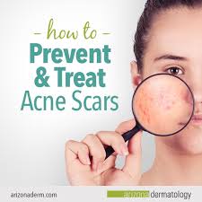 how to prevent and treat acne scars