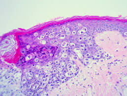 It is usually associated with an underlying breast cancer. Extramammary Paget Disease Pathology Dermnet Nz