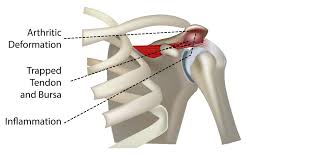 The small size of the glenoid fossa and the relative laxity of the joint capsule renders the joint relatively unstable and prone to subluxation and. Anatomy Pathology Treatment Of The Shoulder Joint Articles Advice White House Clinic