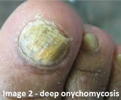 fungal toe nail treatment the natural