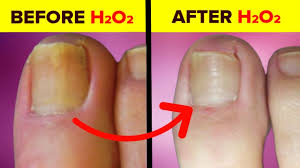 Be it a toenail fungus or fingernail fungus, it is very painful and embarrassing to deal with it. Treat Nail Fungus With Hydrogen Peroxide Hint Soak Your Feet Hands Youtube