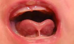 tongue tie miller family pediatrics