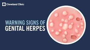 what to do during a herpes outbreak