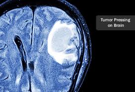 Visual Guide To Brain Cancer