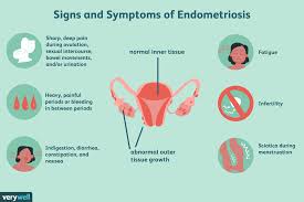 12 natural remes for endometriosis