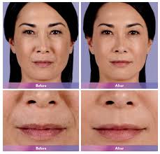 dermal fillers