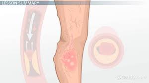Difference Between Arterial Ulcers Venous Ulcers