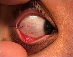 unilateral eye irritation mdedge