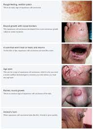 skin cancer treatments by dermatologist