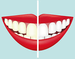 How to whiten coffee stained teeth. Tooth Whitening Versus Stain Removal Bdj Team