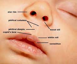cleft lip and palate types