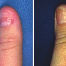 scarred nail bed with intact lunula
