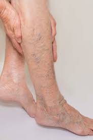 However, some individuals may experience fatigue or pain in the area. 10 Home Remedies For Varicose Veins