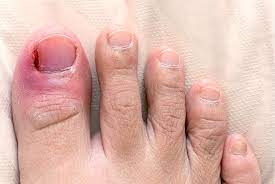 podiatrist for ingrown toenail atlas