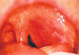 acute pharyngitis tonsillitis and