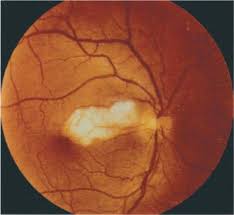 In 1924, uhthoff first described severe visual loss. Arteritic Anterior Ischemic Optic Neuropathy Ento Key