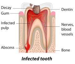 abscessed teeth southlake endodontics
