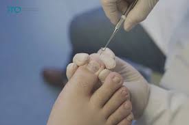 ingrown toenails symptoms treatment