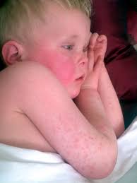 The appearance of viral skin rashes can vary. When Does A Child S Rash Warrant A Call To The Doctor The Dermatology Clinic