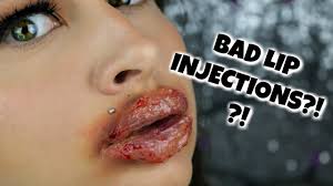 bad lip injections beautybyjosiek