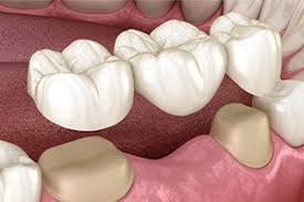 dental bridge cost factors types