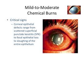 chemical burns to the eye the eye