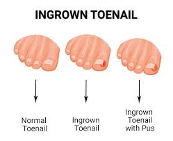 identifying when your ingrown toenail