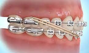 Because of this action, we can bring a protruded or retruded tooth back to its normal position and correct many cases like overbite or underbite. How To Put Rubber Bands On Braces Premier Orthodontics