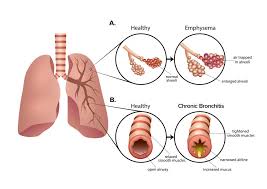 Chronic obstructive pulmonary disease (copd) is airflow limitation caused by an inflammatory response to inhaled toxins, often cigarette smoke. Copd A Closer Look At Stem Cells