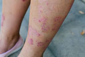 when should i worry about my leg rash