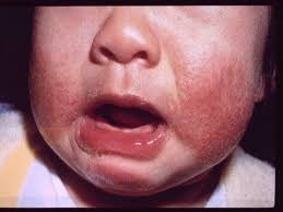 baby eczema natural remes for this