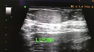 lipoma ultrasound you