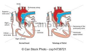 Image result for royalty free images of heart with hole in septum