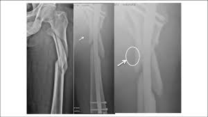 proximal femur shaft fracture treated