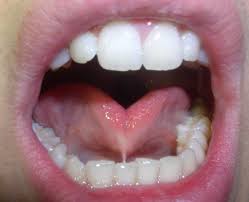 what a frenectomy is and why your child
